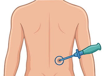 PCNL Minimally Invasive
