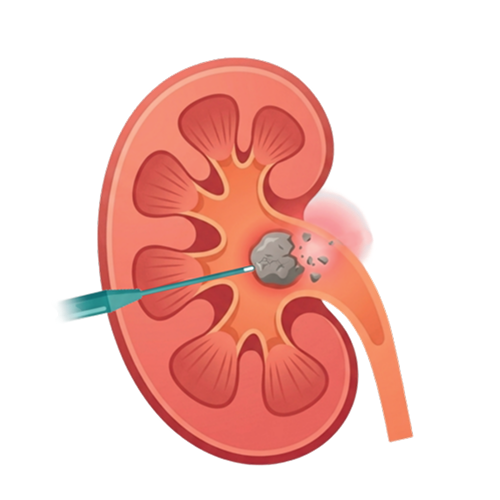 Advanced Kidney Stone Care (PCNL)