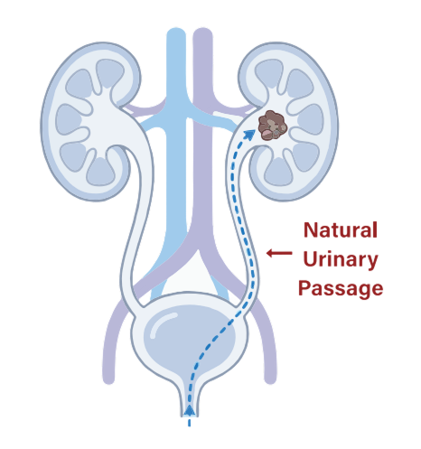 RIRS natural urinary passage procedure